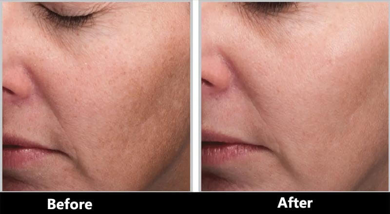 thulium laser treatment before and after