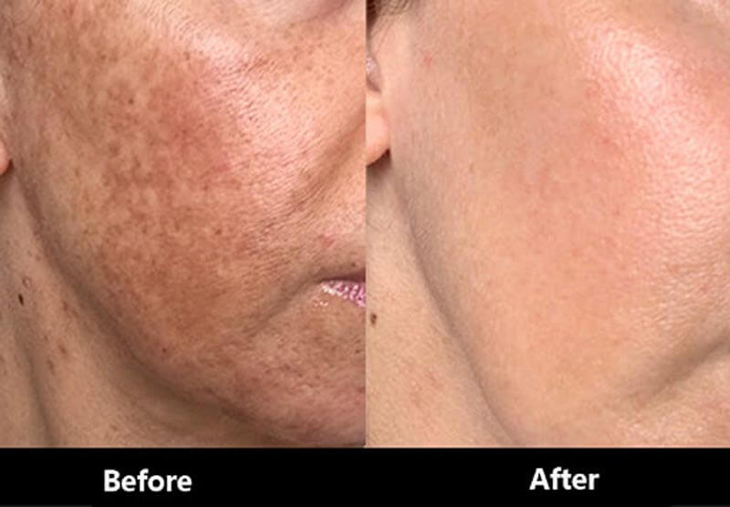 thulium laser treatment before and after