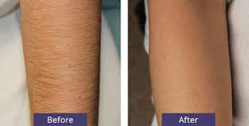 laser hair removal treatment