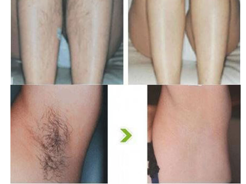 diode laser hair removal treatment before and after