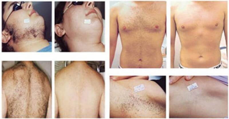 diode laser hair removal treatment