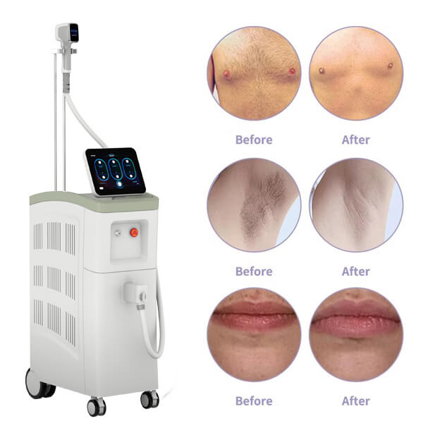 The High Power Diode Laser: A Comprehensive Guide to Aesthetic Treatments