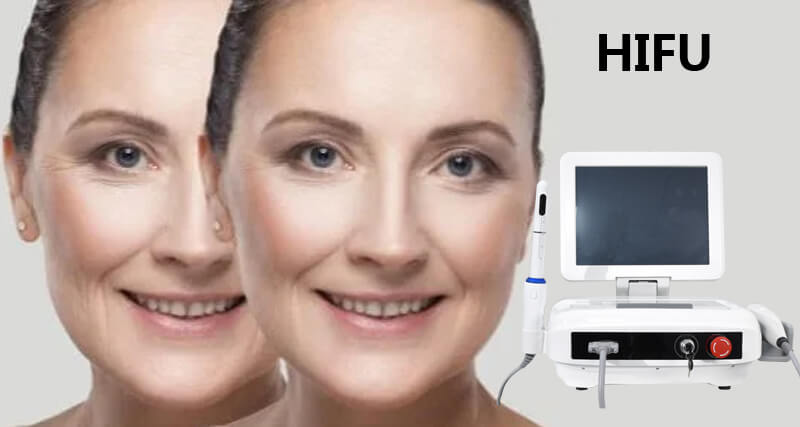 HIFU skin tightening machine