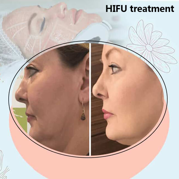 Understanding HIFU High Intensity Focused Ultrasound for skin rejuvenation