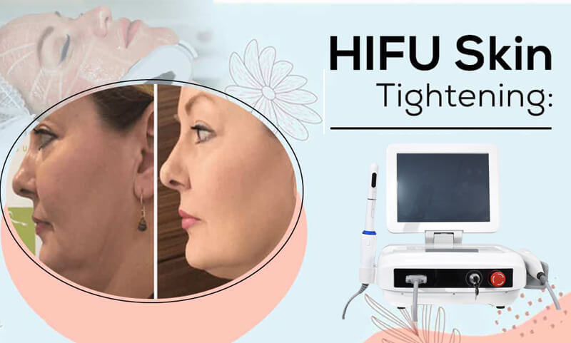 hifu skin tightening machine