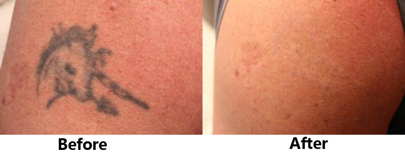 picosecond laser treatment before and after