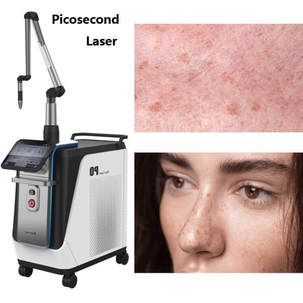 How Long To See Results From Picosecond Laser Treatments (Timeline)