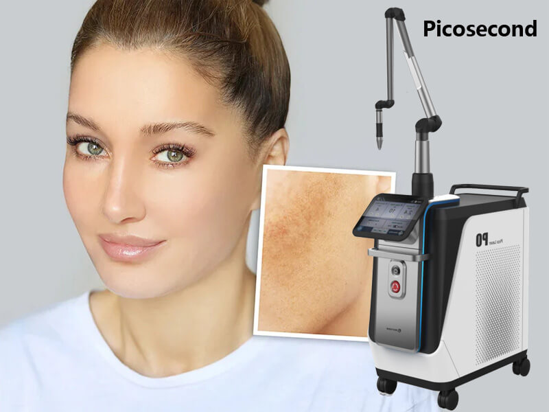 picosecond laser tattoo removal machine