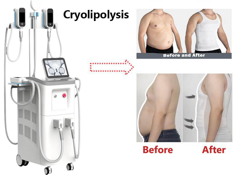 cryolipolysis fat freezing machine