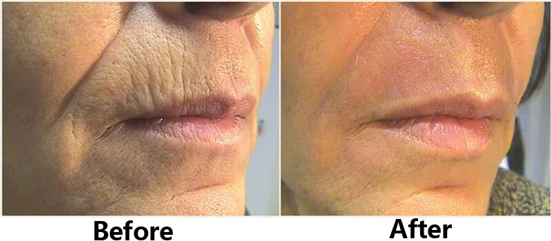 co2 laser skin resurfacing