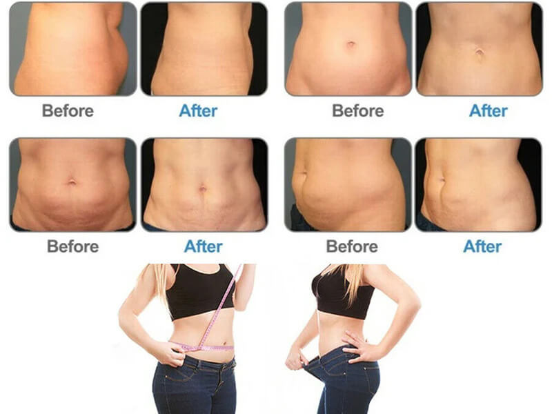 cryolipolysis treatment