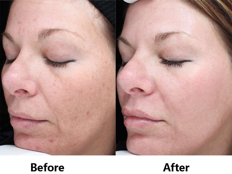 erbium laser resurfacing