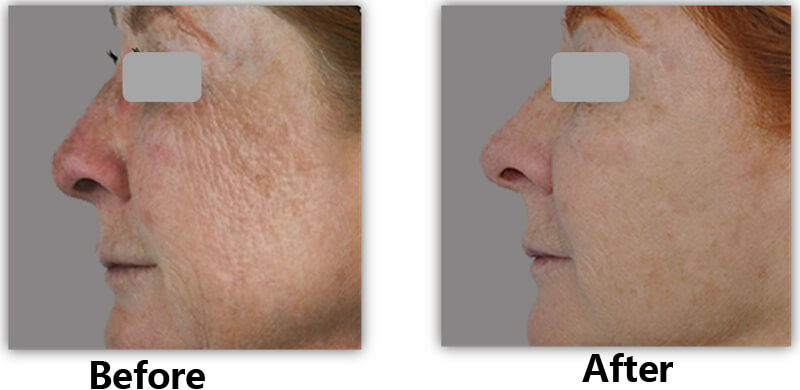 erbium laser skin resurfacing