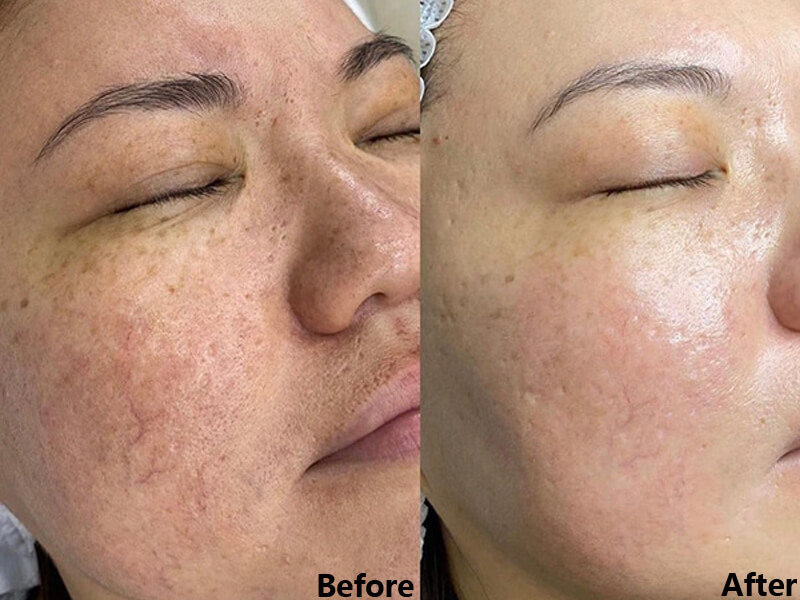 erbium laser skin resurfacing