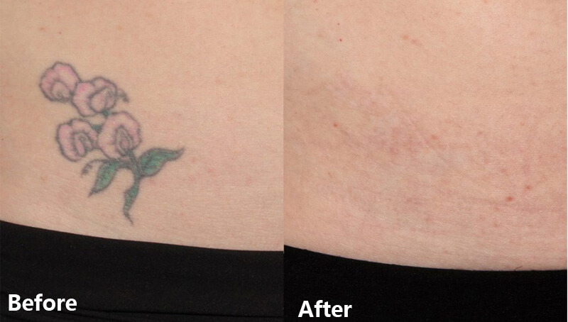 picosecond laser treatment