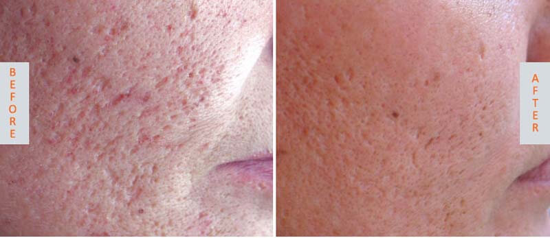 co2 laser skin resurfacing