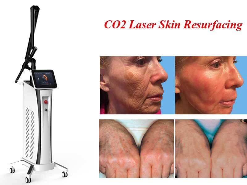 co2 laser skin resurfacing machine