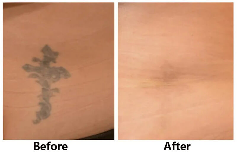 picosecond laser treatment