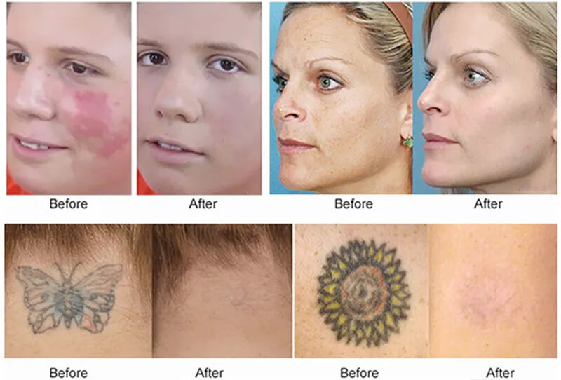 picosecond laser treatment