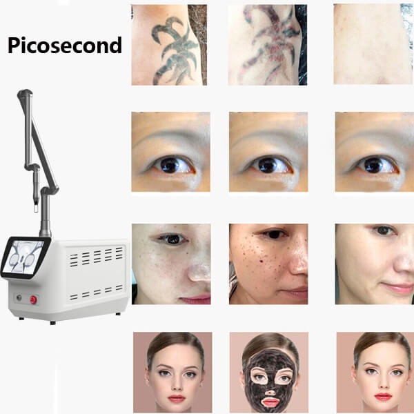 Picosecond Laser Facial Revitalization: Improving Sun-Damaged, Aged or Scarred Skin