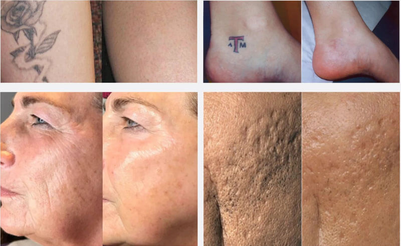 picosecond laser treatment before and after