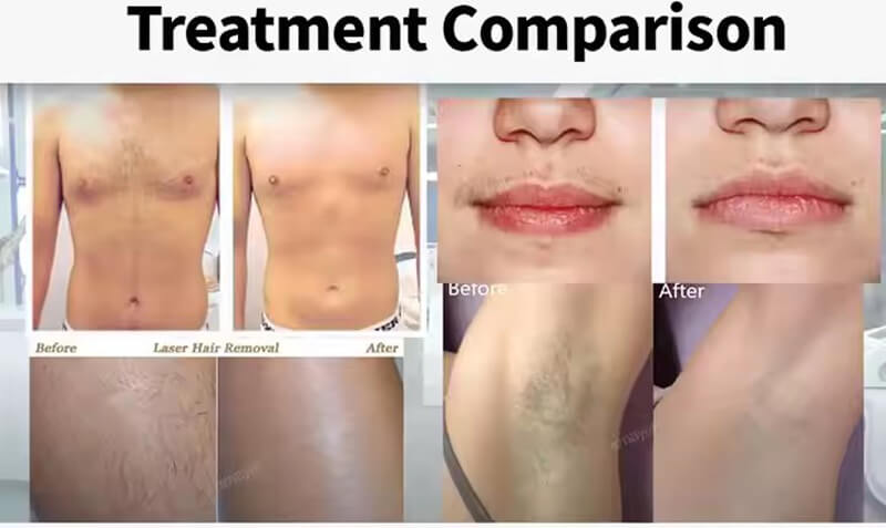 diode laser hair removal treatment