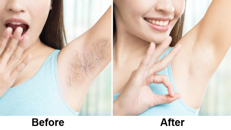 laser hair removal treatment