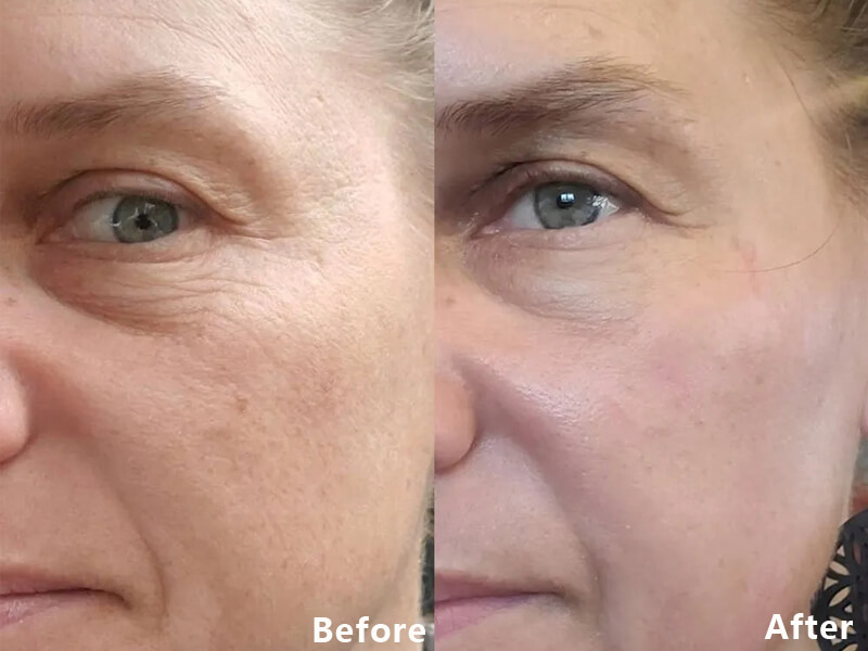 erbium laser resurfacing
