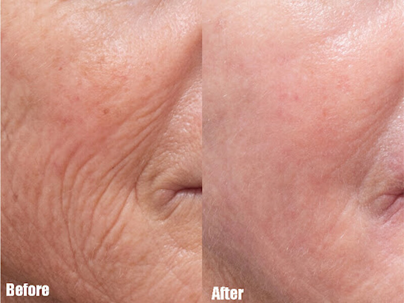 thulium laser treatment
