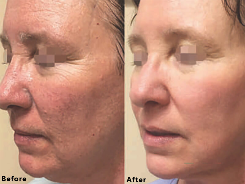 erbium laser resurfacing