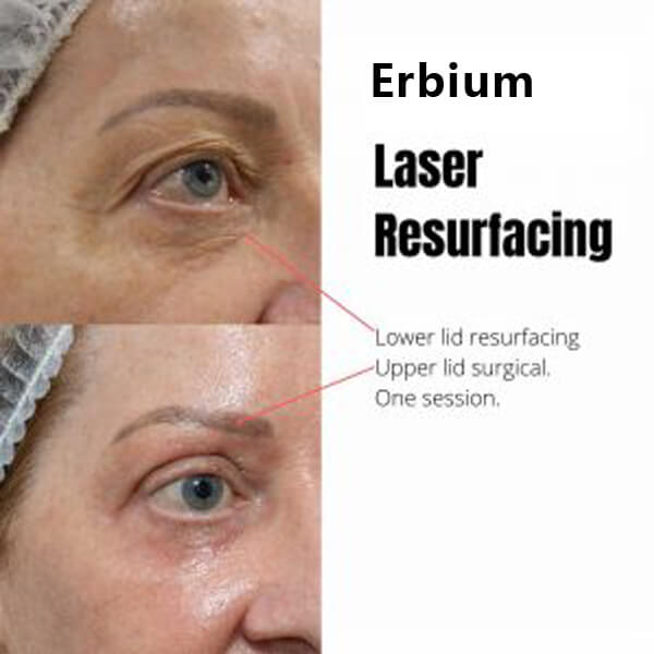 erbium laser machine