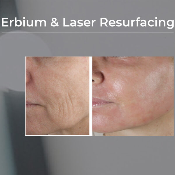 erbium laser resurfacing