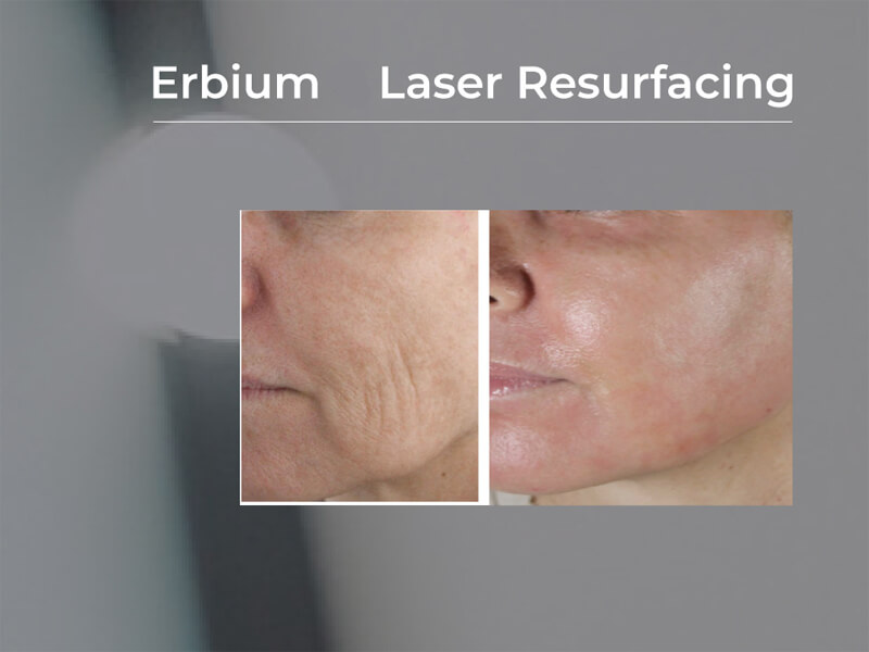 erbium laser machine