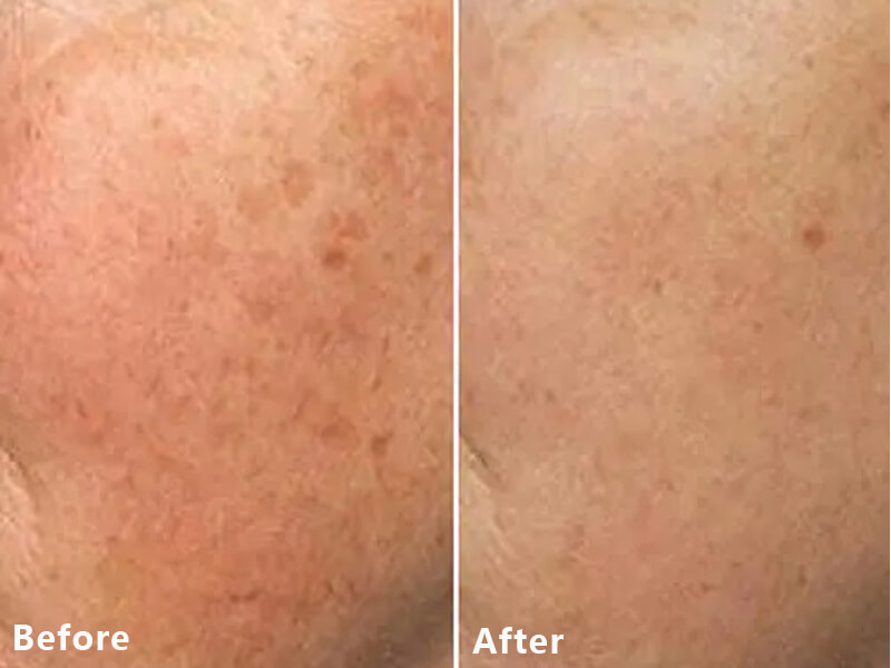 thulium laser treatment
