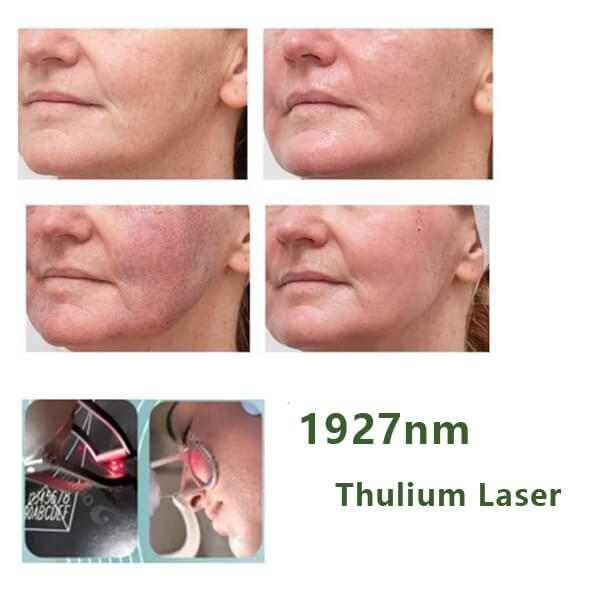 thulium laser machine