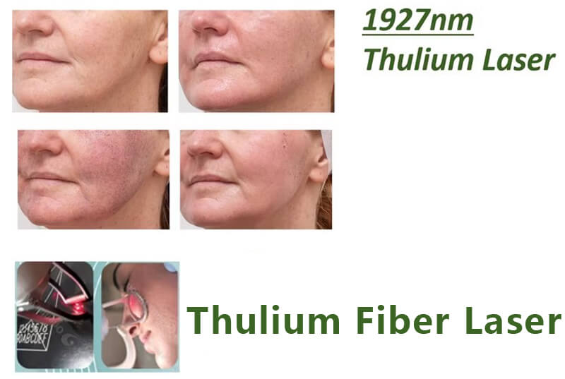 fractional thulium laser