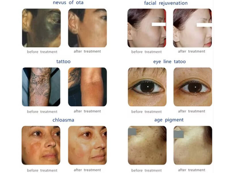 picosecond laser treatment