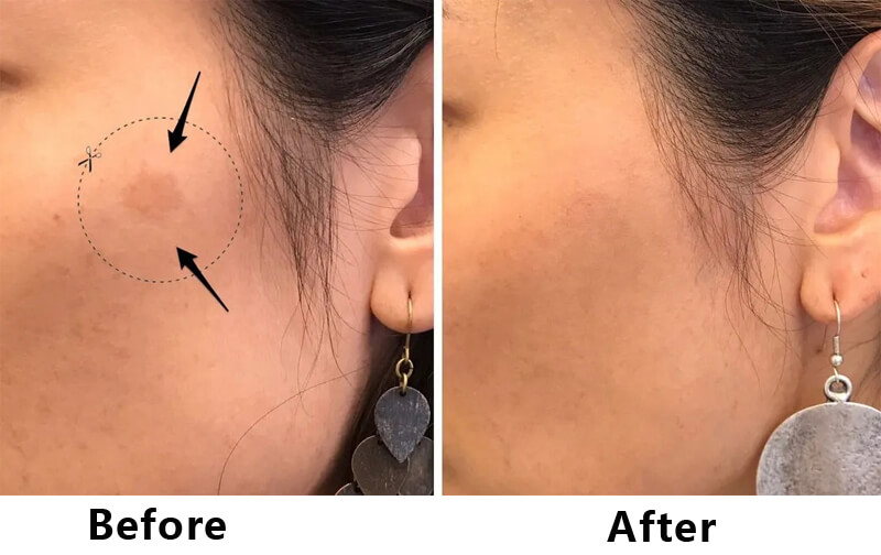 picosecond laser treatment before and after