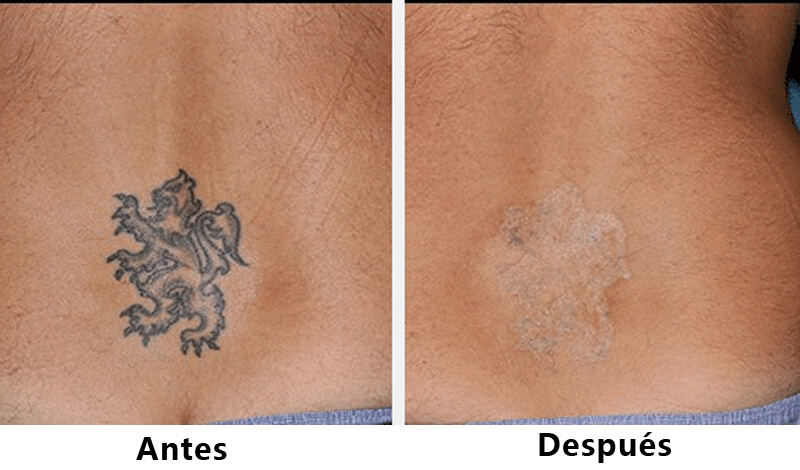 picosecond laser treatment