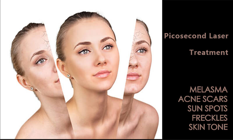 picosecond laser machine