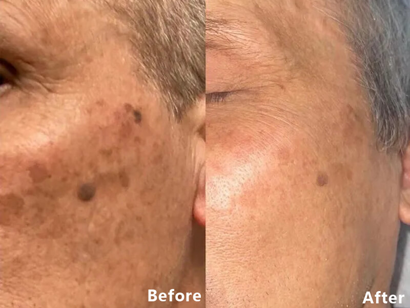thulium laser treatment