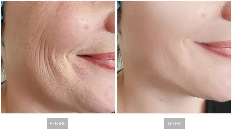 thulium laser treatment