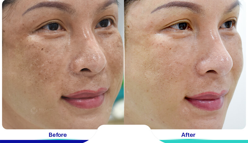 thulium laser treatment