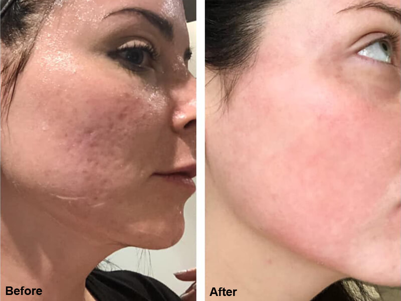 co2 laser treatment