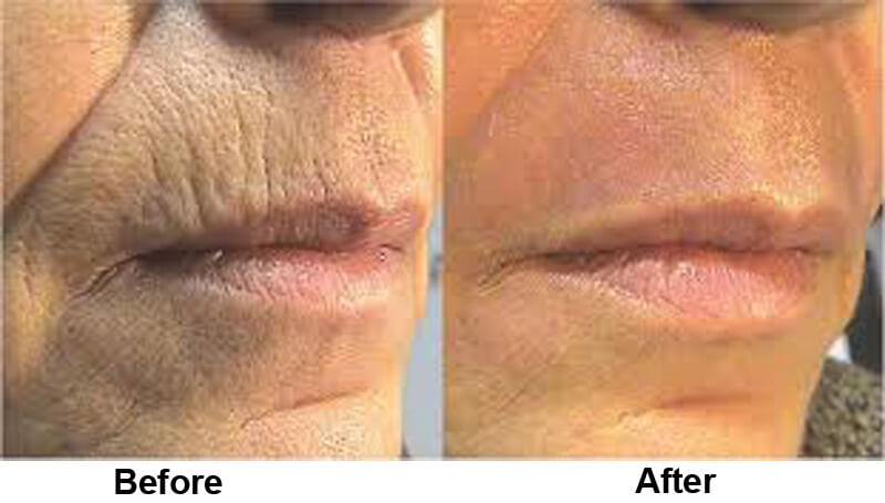 co2 laser skin resurfacing