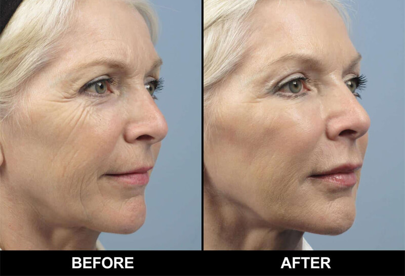 co2 laser treatment