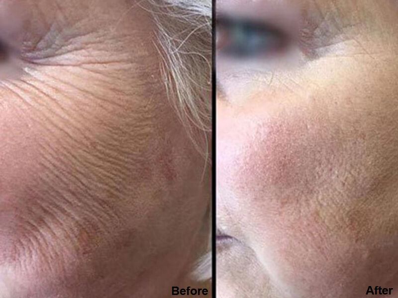 erbium laser resurfacing