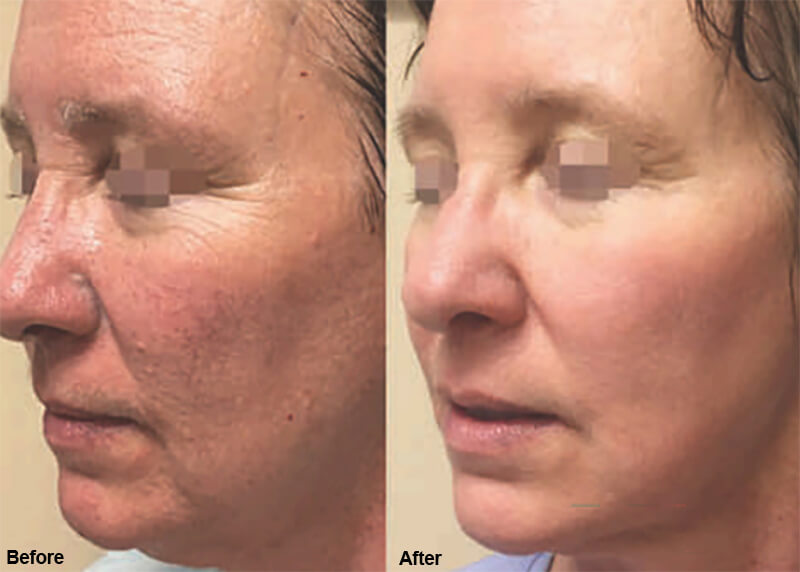 erbium laser treatment