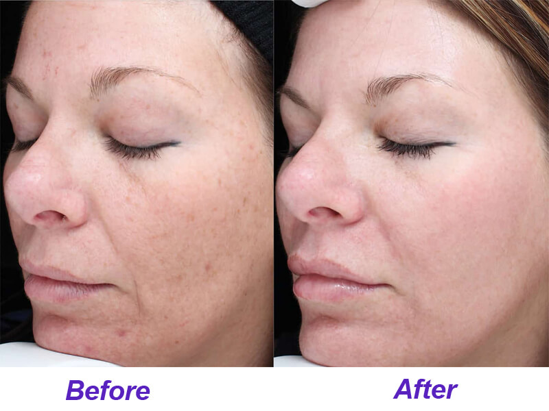 erbium laser treatment