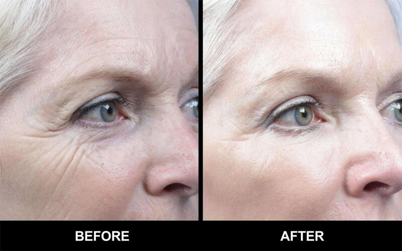 erbium laser resurfacing